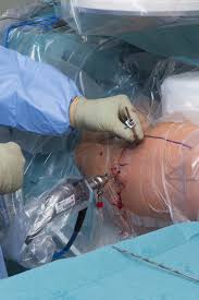 Hip Arthroscopic Surgery